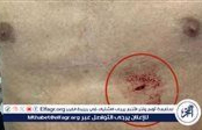 فريق طبي بمستشفى المنصورة الدولي ينقذ شابًا من موت محقق بعد طعنة مباشرة في القلب