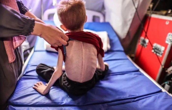 استشهاد 14 فلسطينيا في غزة بينهم 7 بسبب التجويع وسوء التغذية
