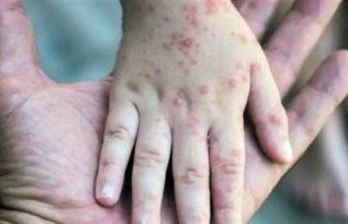 الصحة العالمية: جدري القرود ما زال يمثل تهديدًا عالميًا