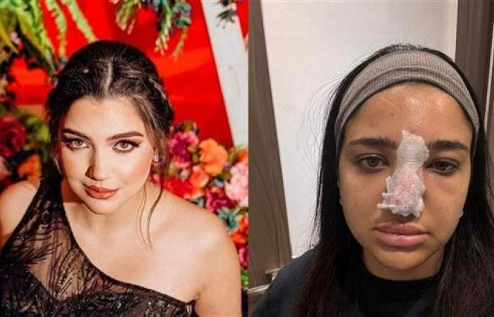 بعد حادث كنزي مدبولي.. خبيرة تجميل تكشف للوفد مخاطر فيلر الأنف وعلاقته بمثلث الخطر