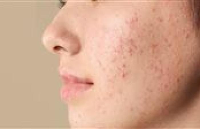 مشاكل البشرة الشائعة.. بين الأسباب والعلاج