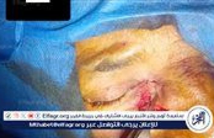 نجاح جراحي جديد بالسنبلاوين: استئصال ورم سرطاني جلدي وإعادة بناء تجميلي للوجه